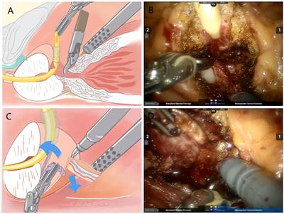 Modified anterior approach preserving Retzius space versus standard anterior approach robot-assisted radical prostatectomy: A matched-pair analysis